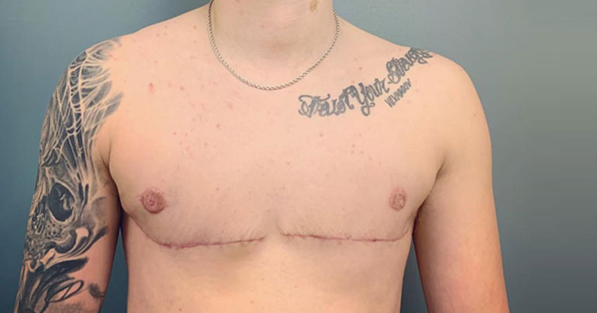 Top surgery dobbel mastektomi trans kjønnsinkongruens kjønnsdysfori